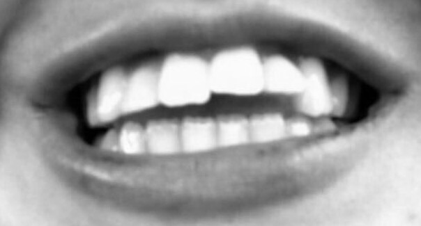 Should I File My Tooth With A Nail Filer Glow Community Should I File My Tooth With A Nail Filer