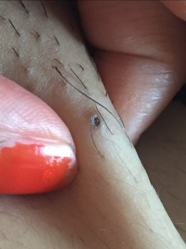 Ingrown Hair Help Glow Community