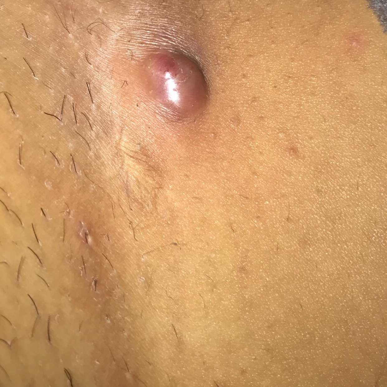 In The Crease Between My Thigh And Vagina What Is It And How Can I