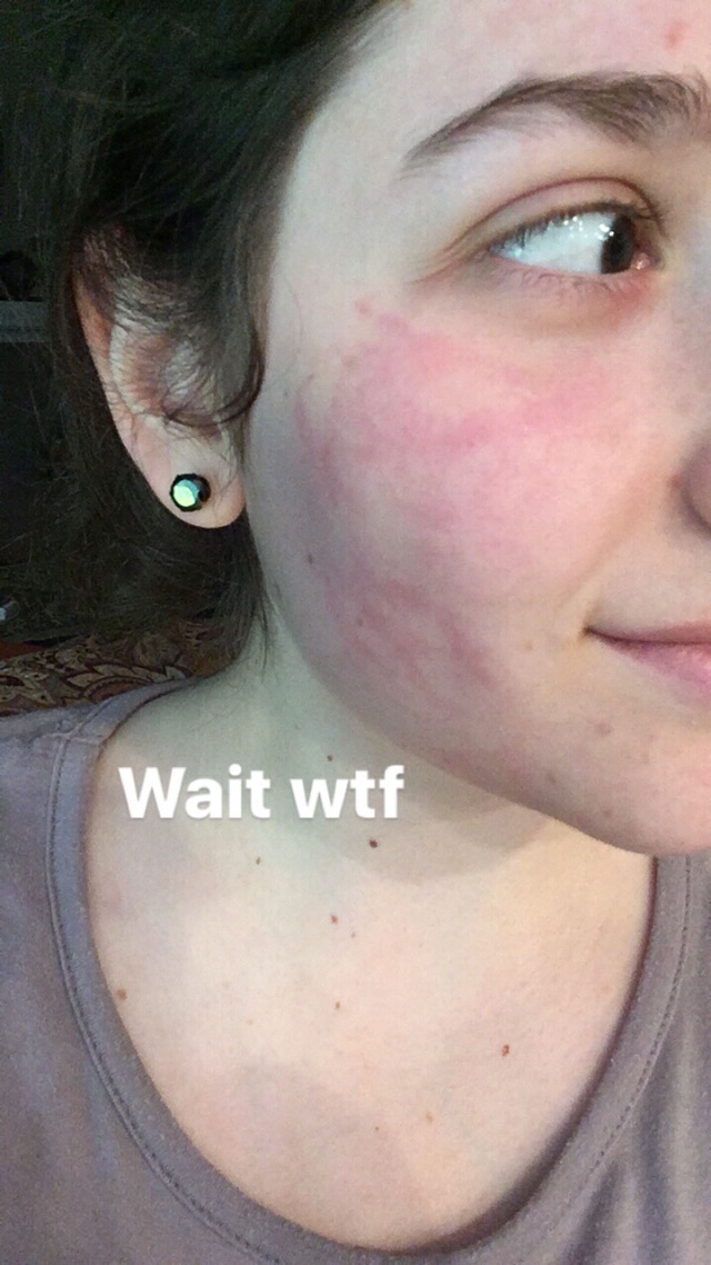 Skin Allergic to Greek Yogurt but not Regular Yogurt? Glow Community