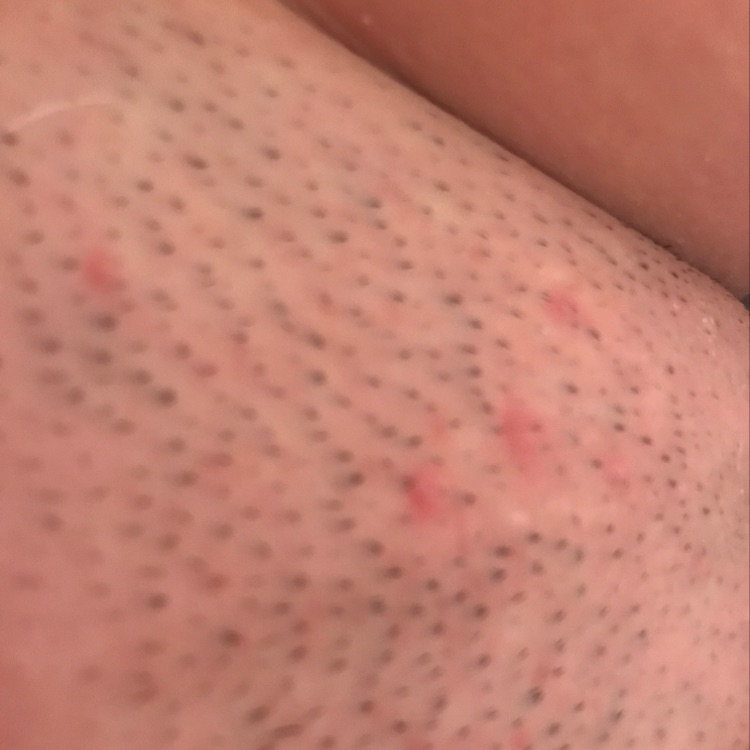 Razor Burn