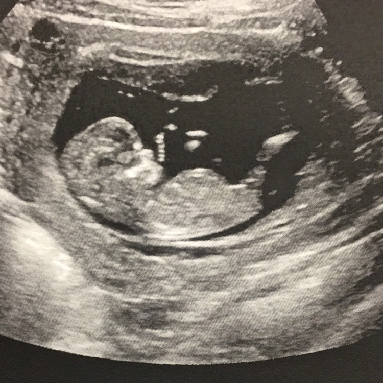 boy or girl nuchal scan went great baby is measuring couple days