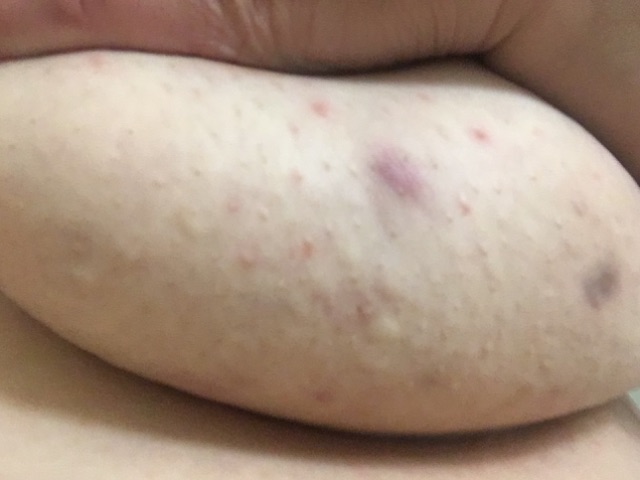 Whiteheads Clogged Pores Under Boobs Glow Community