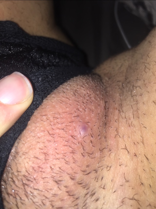 Ingrown Hair Or Genital Wart Glow Community