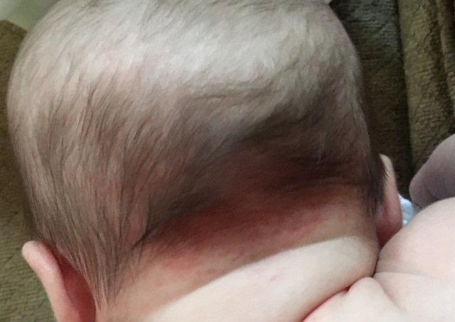 stork bite? Glow Community