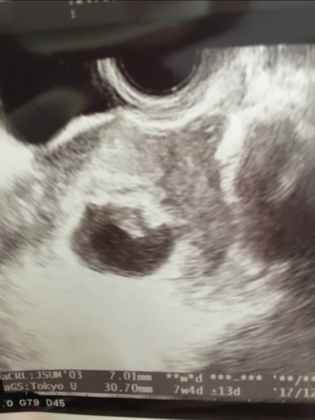 anyone experience a miracle like stop growing the fetus and no fetal