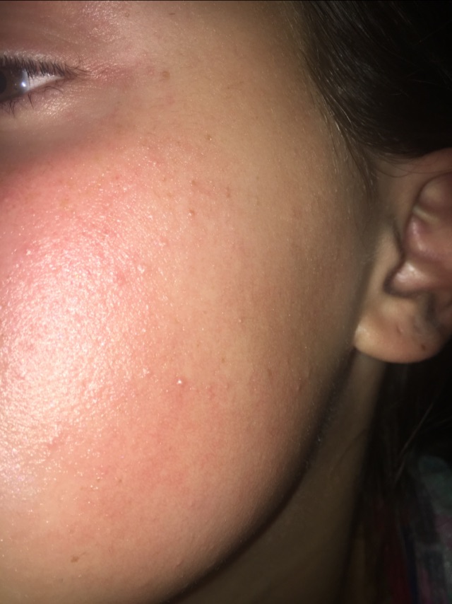 what are these bumps and why is my face red Glow Community
