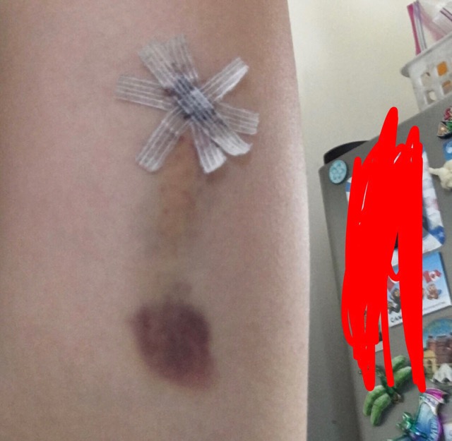 Nexplanon healing process Glow Community