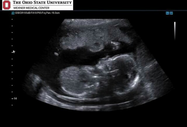 20 Week Anatomy Scan No Clue What It Is Well A Baby Of Course 