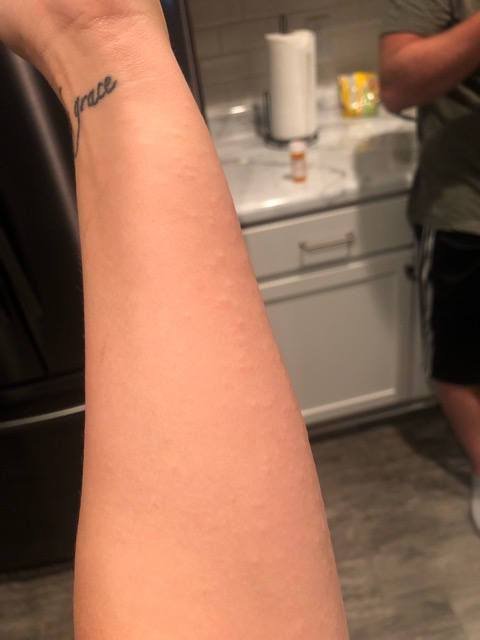 Bed Bugs Or Hives Glow Community