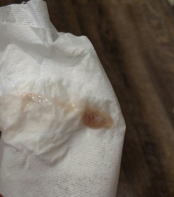 Whats going on? Mucus plug/bloody show - Glow Community