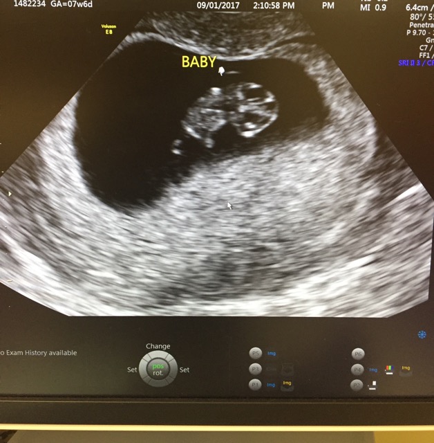 Transvaginal Ultrasound Bleeding Glow Community My XXX Hot Girl