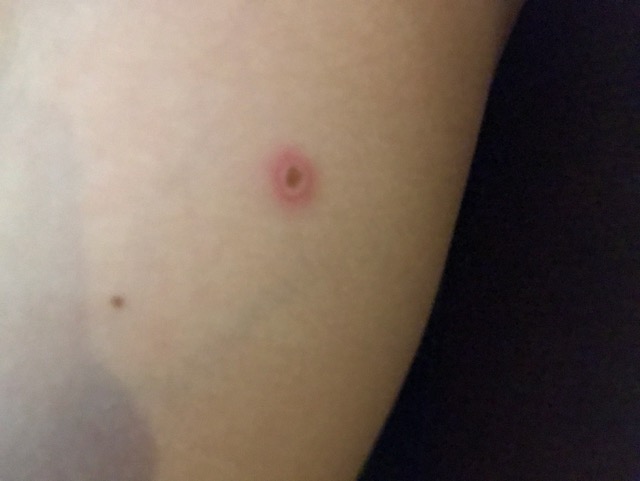 Is This The Beginning Stage Of Mrsa Bug Bite Pimple Glow