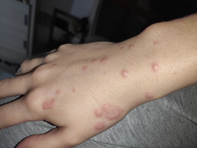 Red Spots On Arms Glow Community