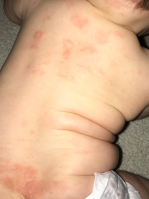 6 Month Old Rash On Back Glow Community 6-month-old-rash-on-back-glow-community