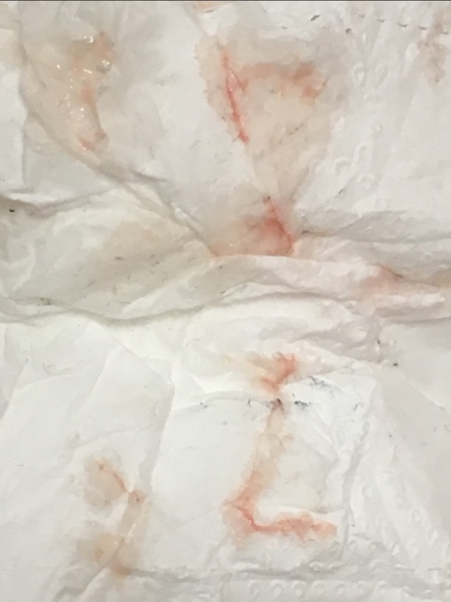 tmi-is-this-implantation-bleeding-glow-community