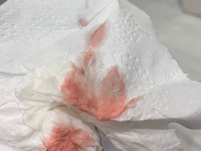 help-pregnancy-scare-is-this-spotting-before-period-or-implantation