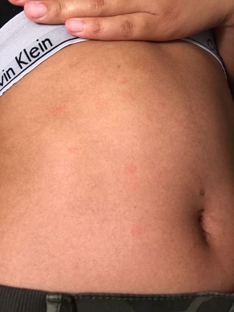 Help Random Red Dots On Skin Glow Community