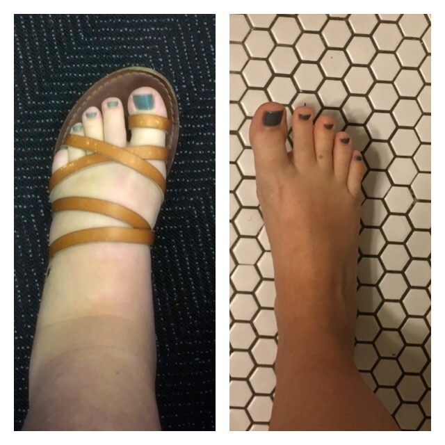 Swollen feet while flying! Glow Community