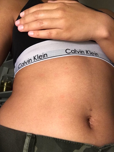 Help Random Red Dots On Skin Glow Community