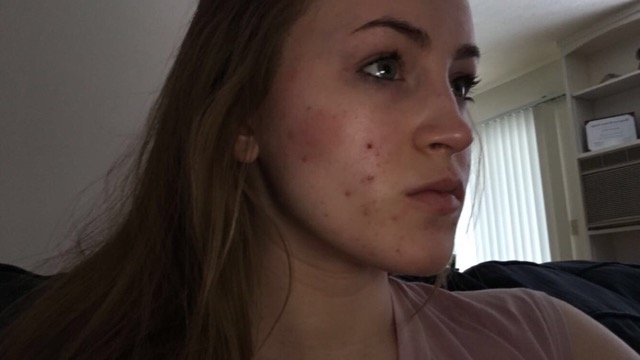loestrin for acne