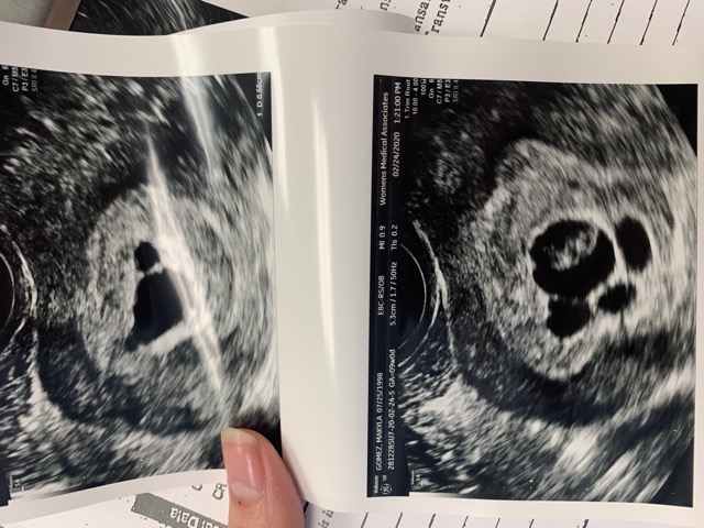 Partial molar pregnancy ? - Glow Community
