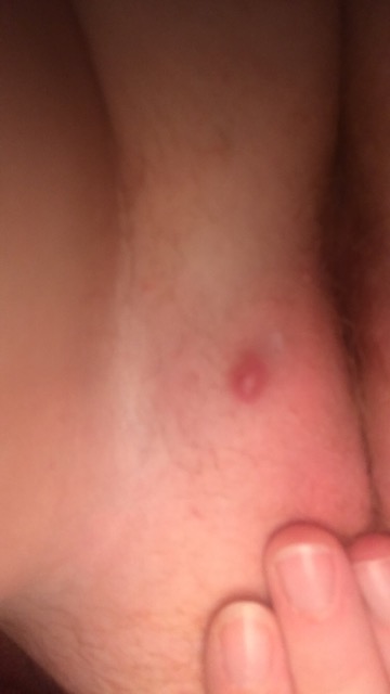 Painful Bump Glow Community