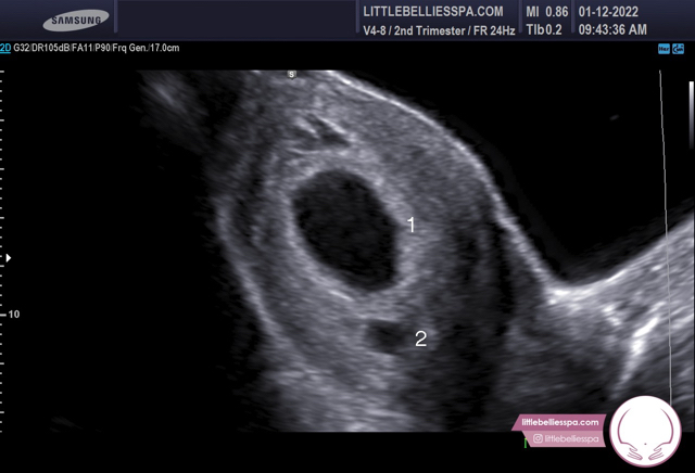 6 weeks and 3 days ultrasound pregnant with twins - Glow Community