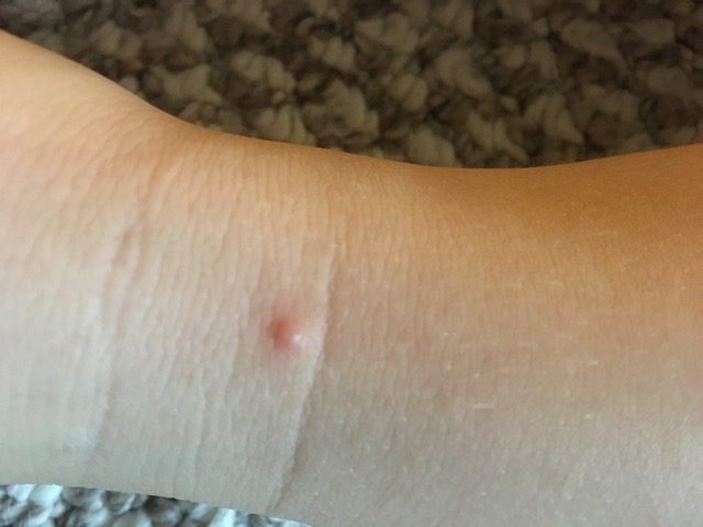 Random Bumps On Toddler Glow Community