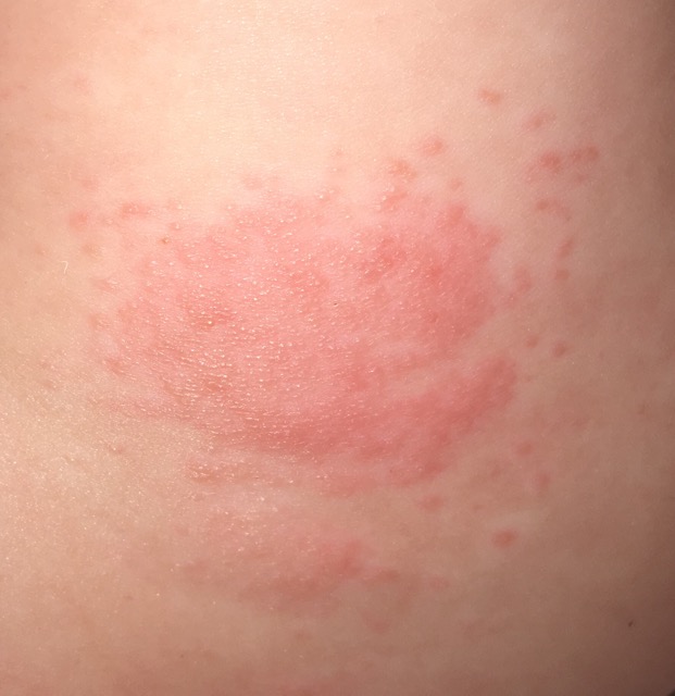 Allergy to diaper? Glow Community