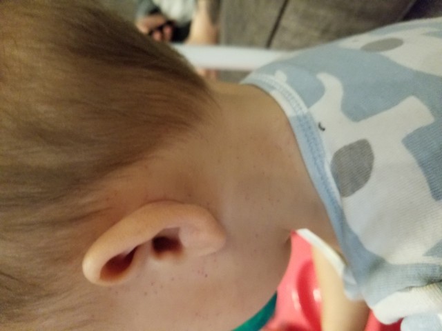 Baby Has Popped Blood Vessels All Over Face And Neck Glow Community