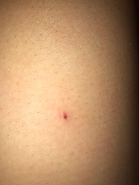Blackhead Ingrown Hair Glow Community