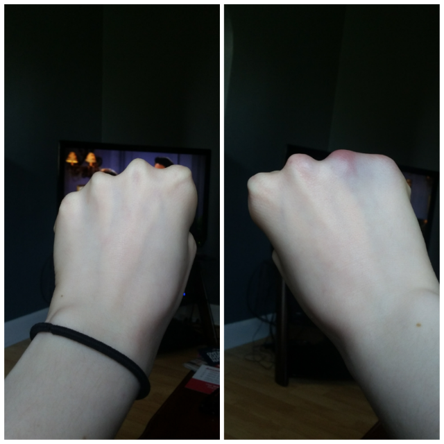 Broken Knuckle???? (blurred in case you're squeamish!) Glow Community