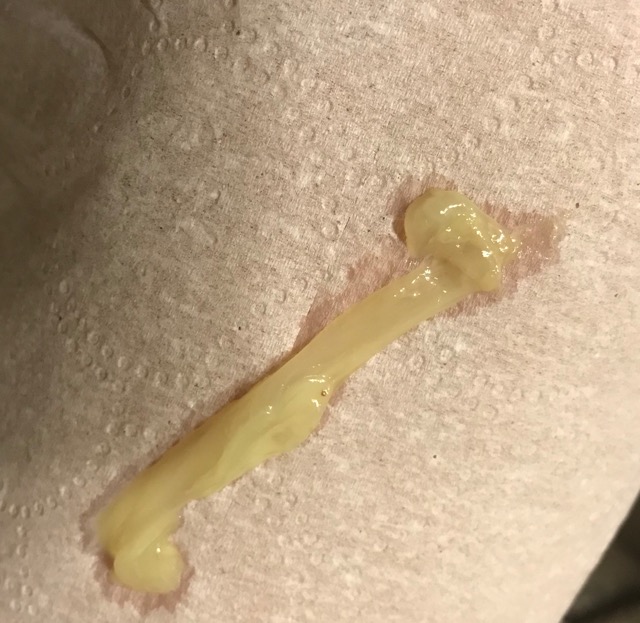Mucus Plug In Nose