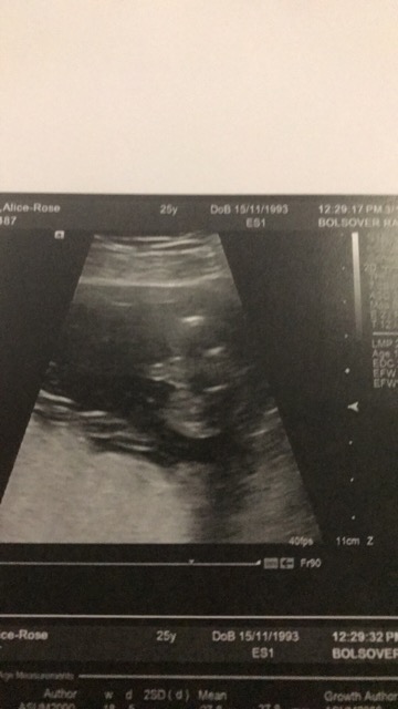 18 week scan - Glow Community