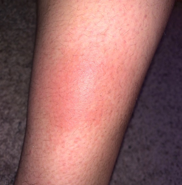 Eczema? Rash? Ringworm? Psoriasis? HELP Glow Community