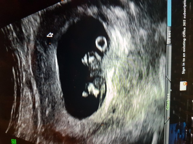 9 Week Ultrasound Looks Abnormal Glow Community