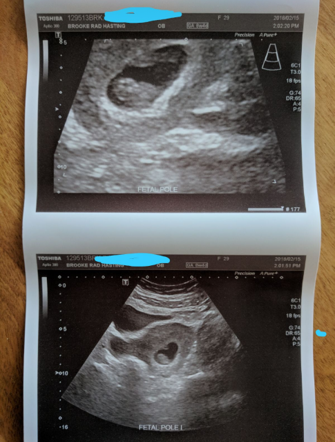 8 Weeks 4 Days Ultrasound - Glow Community
