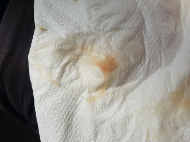 So I Had Weird Discharge That Sorta Looks How My Mucus Plug Did With My 