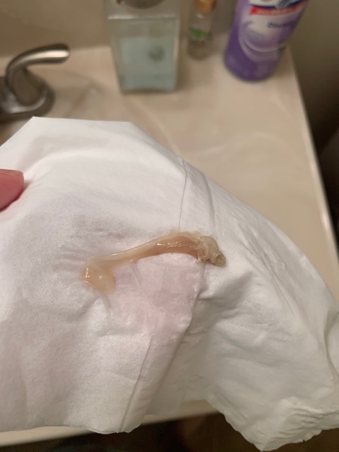Did I Lose My Mucus Plug I m So Paranoid I m 21 Weeks Pregnant And 