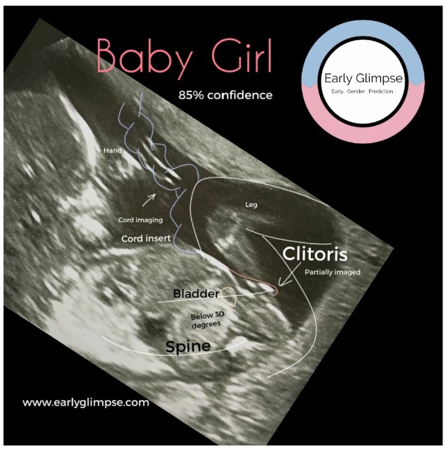Had early glimpse look over my scan, they've predicted girl with 85