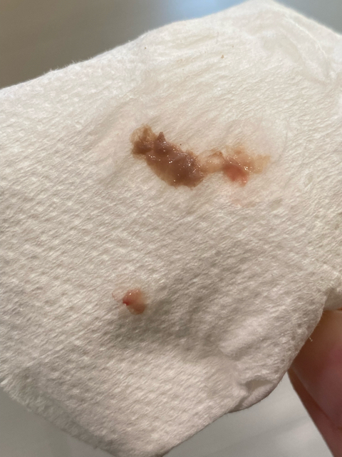 Chemical pregnancy? Ectopic? Miscarriage? Or is this normal. I am about