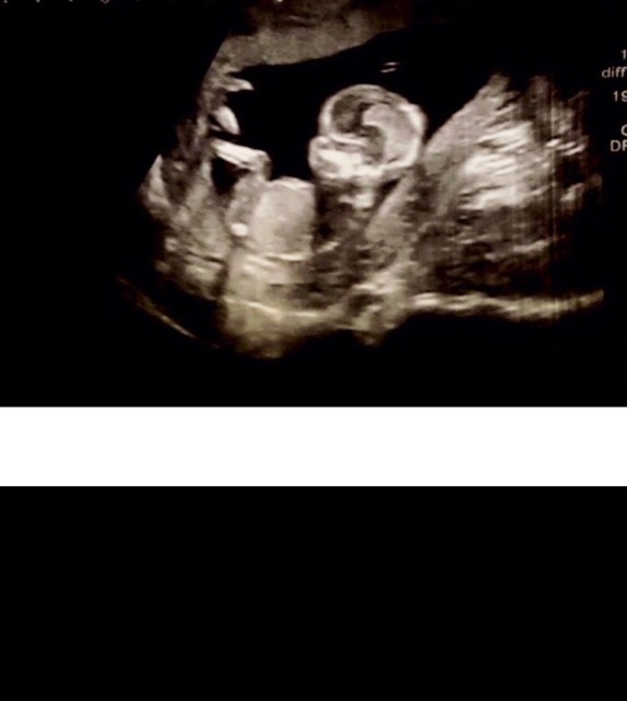 Where The Genital Area Is There Is A White Blob This U s Is At 14w Is 