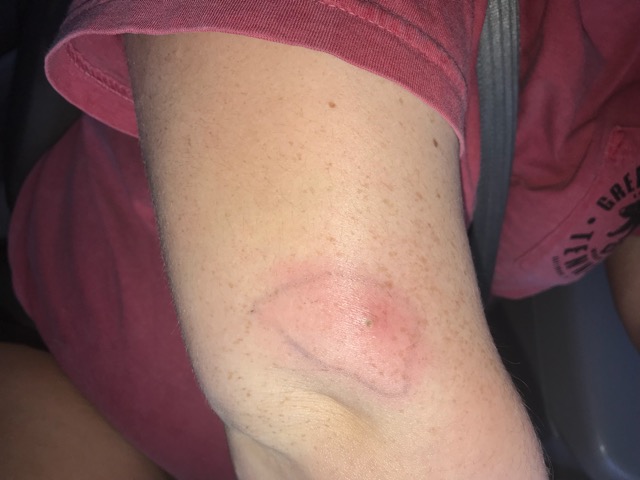 Spider Bite Staph Infection Infected Mosquitoe Bite Hot To Touch Very Sore Nothing But Clear 