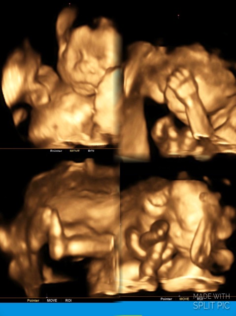 23 weeks 3D ultrasound - Glow Community
