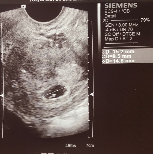 how-many-weeks-do-you-think-i-am-by-looking-at-this-scan-no-heartbeat