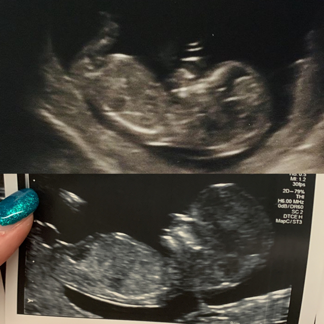 Top was my daughter, bottom is my 12 week scan with my second. Using