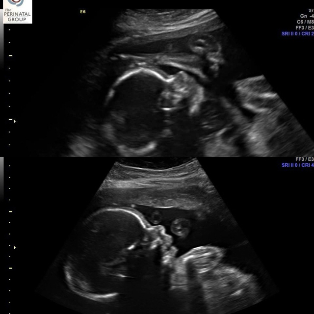 Is it normal for my baby’s head to look like it’s swollen?? The bottom