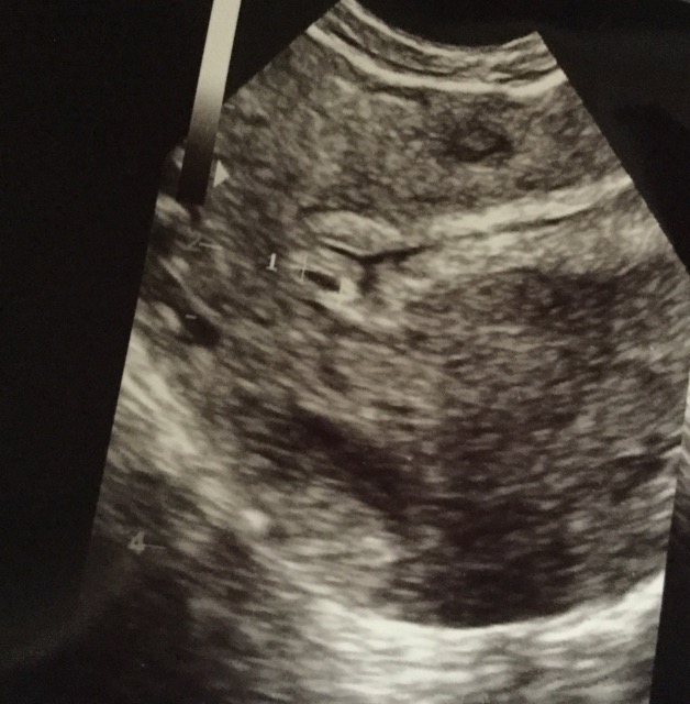 Went For 6wks Ultrasound And All They Saw Was A Small Gestational Sac 