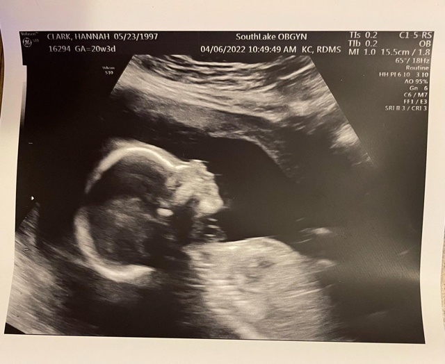 20 week ultrasound😭 ️ little boy with the cutest nose Glow Community